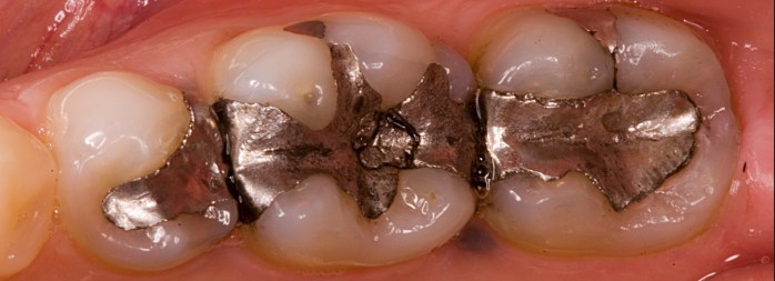 amalgam filling